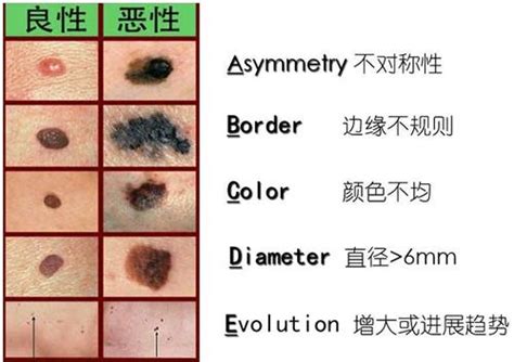 痣好壞|醫師告訴你 怎麼分辨「好痣」、「壞痣」